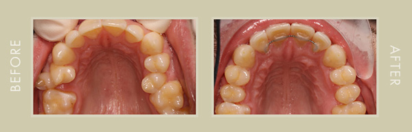 Orthodontic-Before-and-After-600px.jpg
