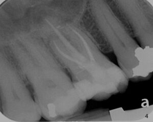 root canal post operation