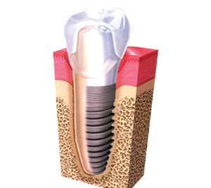 FREE Dental Implant Consultation